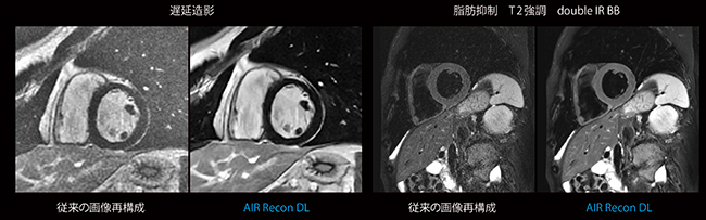図4　AIR Recon DLと従来画像再構成法による画像比較（同一のraw dataを使用） AIR Recon DLにより，大幅な画像ノイズ低減が見られる。