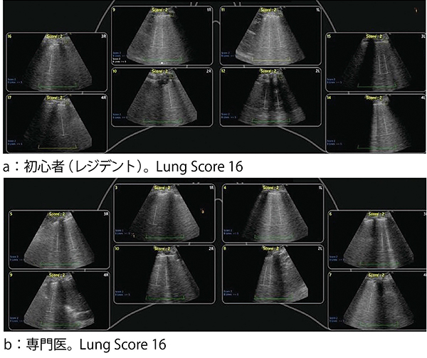 図3　Automated B-line　ダイアグラムの検者比較 （画像ご提供：済生会宇都宮病院・藤田健亮先生）
