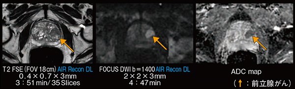 図3　1.5T装置におけるPI-RADSに準拠した前立腺撮像例