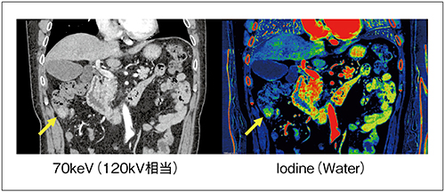図1　Iodine画像による造影効果強調（→：上行結腸がん）