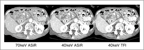 図2　低keV画像におけるASiRとTFIの比較（膵頭部腫瘍）