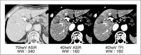 図3　低keVとnarrow windowを組み合わせた低コントラスト強調画像（肝腫瘍）