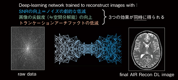 図4　AIR Recon DLによる画像再構成の効果について