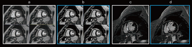 図1　ディープラーニング画像再構成による画質改善効果 a：従来のシネ撮像（1.8mm×1.8mm×6mm，3：45） b：Sonic DLによるシネ撮像（1.8mm×1.2mm×6mm，1：55） c：従来の遅延造影 d：AIR Recon DLを併用した遅延造影