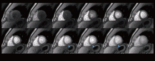 図2　AIR Recon DL＋MoCoによる心筋パーフュージョン ▲：micro vascular obstruction
