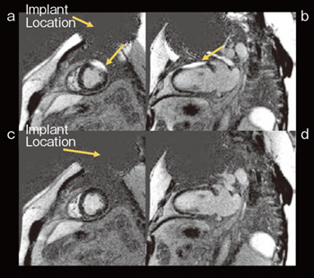 図3　Broadband adiabatic IRパルスによるアーチファクト低減 従来の遅延造影短軸像（a）と長軸像（b）。broadband adiabatic IRパルスによる遅延造影短軸像（c）と長軸像（d）。broadband adiabatic IRパルスにより，CIEDsの影響によるアーチファクトが低減されている。