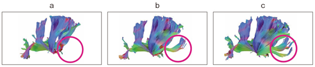 図3　AIR Recon DLと48ch AIRヘッドコイル導入（アップグレード）前後の比較 a：アップグレード前：12chヘッドコイルによる60軸HARDI b：アップグレード後：48ch AIRヘッドコイルによる同条件のHARDI c：bに対してさらにAIR Recon DLを適用