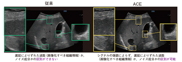 図3　高画質化技術ACEの比較画像 （画像ご提供：北海道大学病院・西田　睦先生，工藤悠輔先生，岩井孝仁先生）