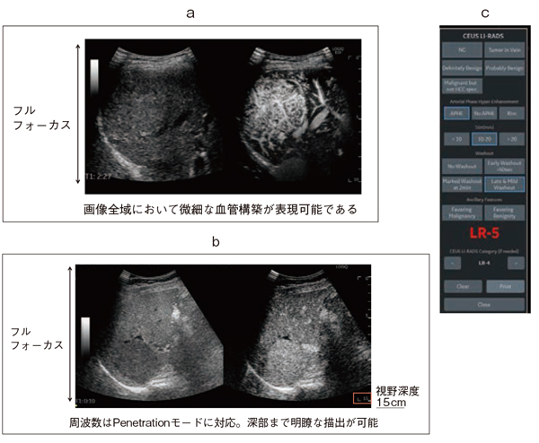 図4　フルフォーカス造影＆レポーティングシステム a：フルフォーカス造影エコー（画像ご提供：日本大学病院・小川眞広先生） b：フルフォーカス造影エコーPenetrationモード（画像ご提供：虎の門病院・齊藤　聡先生） c：LI-RADSに準拠したレポーティングシステム