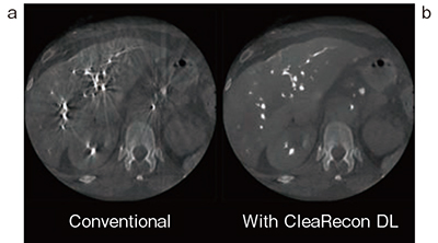 図3　Liver a：CleaRecon DLなし b：CleaRecon DLあり 肝像内の造影された血管からのアーチファクトが軽減されている。