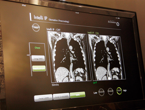Intelli IP（Advanced）を用いることでノイズを低減できる（右，ノイズ低減レベルはLv-7）。