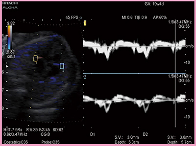 図3　Tissue Dopplerによる両心室の波形計測