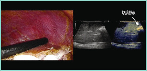 図4　症例1：大腸がん肝転移に対する腹腔鏡下肝S8部分切除