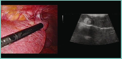 図5　症例2：肝硬変合併肝細胞がんに対する腹腔鏡下肝S3亜区域切除