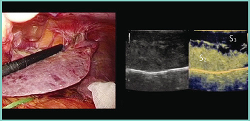 図6　症例2：肝硬変合併肝細胞がんに対する腹腔鏡下肝S3亜区域切除（S3グリソン鞘のクリップ後）