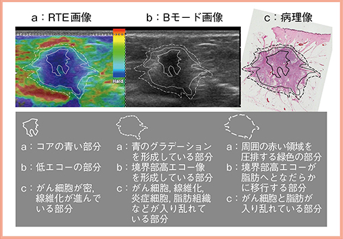 図2　症例2：硬癌におけるRTE画像，Bモード画像，病理像の比較