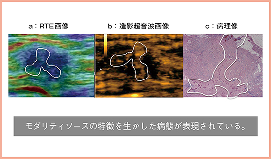 図3　症例3：浸潤性小葉癌におけるRTE画像，造影超音波画像，病理像の比較