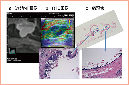 図4　症例4：囊胞内乳頭癌における造影MR画像，RTE画像，病理像の比較