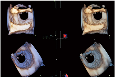 図5　高頻拍症例における僧帽弁の3D zoomの3D画像