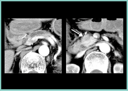 図2　症例1：早期膵癌の造影CT画像