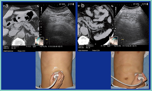 図3　‌RVSを活用した膵尾部の観察のポイント