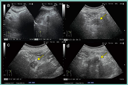 図5　‌超音波による膵尾部癌の描出