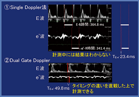 図3　Single Doppler法とDual Gate DopplerによるTE-e’測定の比較（症例1）