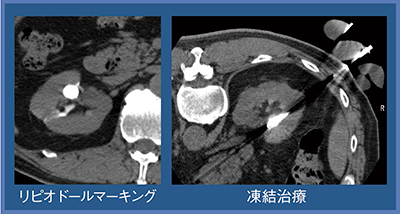 図4　症例2：両側腎癌，右腎に対する凍結療法（60歳代，男性）