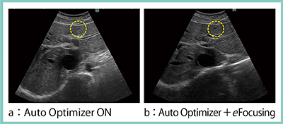 図4　Auto Optimizerとの併用におけるeFocusingの有用性（浅部の肝囊胞，S3，7mm）