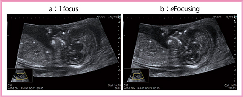 図1　胎児のNT計測画像におけるフォーカスの違い