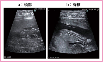図2　4G CMUT（トラペゾイドスキャン）による胎児の画像