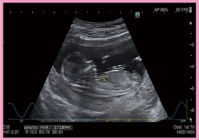 図6　AutoFHRによる胎児心拍数の計測
