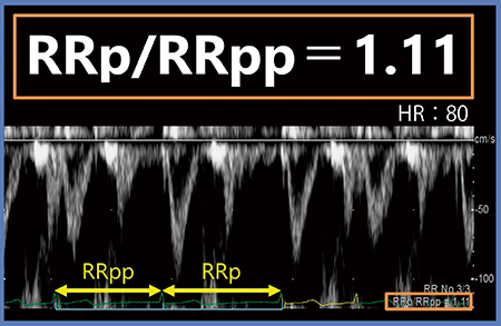 図1　R-R Navigationによる1心拍での先行R-Rと先々行R-Rの正確な計測