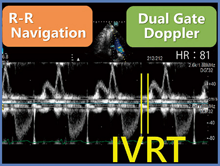 図4　Dual Gate DopplerとR-R Navigationの併用によるIVRTの計測