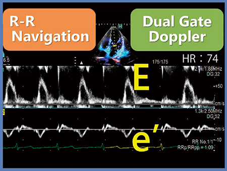 図5　Dual Gate DopplerとR-R Navigationの併用による同一心拍でのE/e’の計測