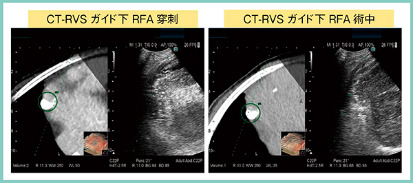 図1　RVSによるRFA治療のナビゲーション