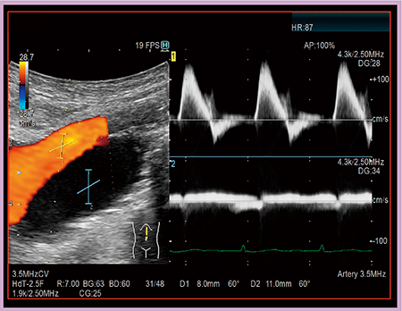図4　Dual Gate Dopplerによる真腔と偽腔の血流評価