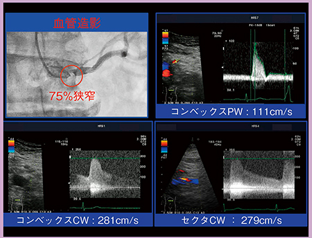 図5　コンベックスCWによる左腎動脈起始部狭窄の診断