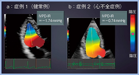 図4　IVPD-IRによる健常例と心不全症例の鑑別（症例1，2）