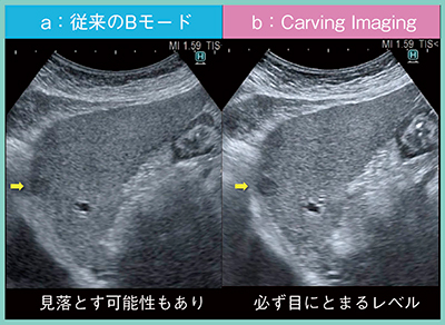 図2　症例1：従来のBモードとCarving Imagingの画像比較（肝細胞がん）