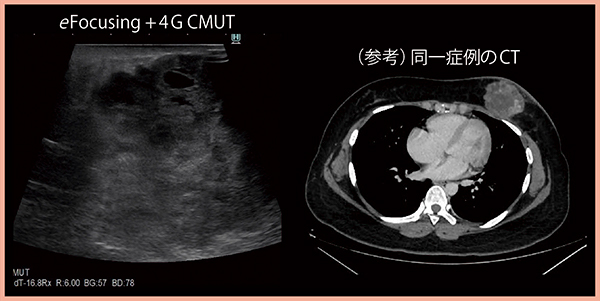 図3　eFocusingと4G CMUTによる病変の良好な描出（6cm大の乳房腫瘤）
