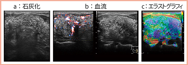 図2　症例2：びまん性硬化型乳頭癌の石灰化（a），血流（b），エラストグラフィ（c）の描出