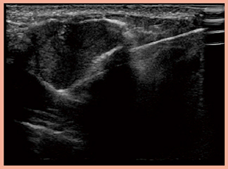 図4　症例4：線維腺腫の超音波ガイド化手術