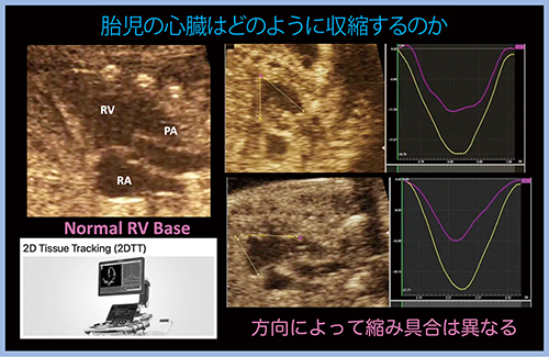 図1　胎児の正常な右室の2D Tissue Trackingによる観察