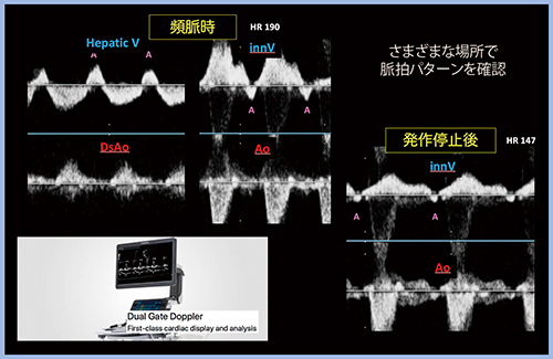 図2　Dual Gate Dopplerによる頻脈波形の確認