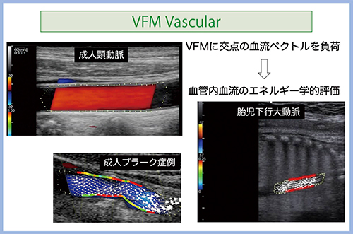 図4　VFM Vascularによる血管評価