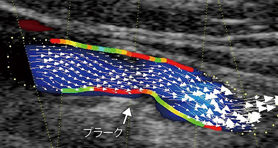図4　内頸動脈プラークの速度ベクトルとWSS