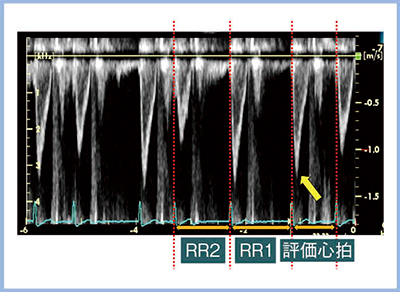 図3　心房細動における評価心拍の検出