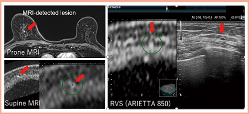 図2　症例1（72歳）：主病巣の乳頭側にMRI-detected lesionを認めた症例