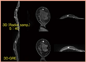 図5　高分解能RVS用MRIの画像